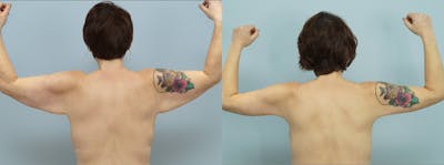 Arm Lift Before & After Gallery - Patient 144402733 - Image 1