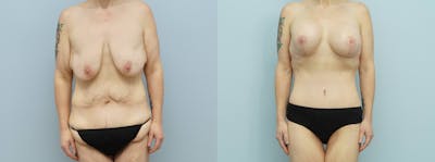 Mommy Makeover Before & After Gallery - Patient 144402878 - Image 1