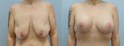 Breast Lift With Implants Before & After Gallery - Patient 144402989 - Image 1