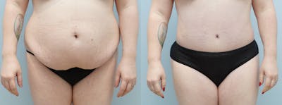 Tummy Tuck Before & After Gallery - Patient 144425443 - Image 1
