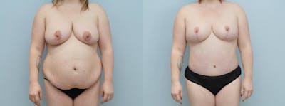 Mommy Makeover Before & After Gallery - Patient 144425500 - Image 1
