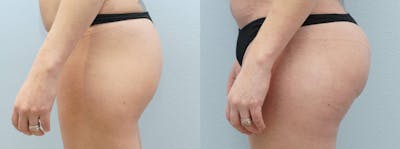Brazilian Butt Lift Before & After Gallery - Patient 144425532 - Image 1