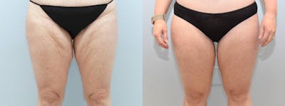 Thigh Lift Before & After Gallery - Patient 144425678 - Image 1