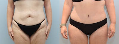 Body Lift Before & After Gallery - Patient 144425692 - Image 1