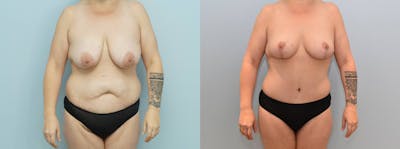 Mommy Makeover Before & After Gallery - Patient 144425707 - Image 1