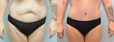 Tummy Tuck Before & After Gallery - Patient 144425718 - Image 1