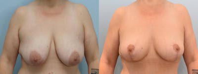 Breast Lift Before & After Gallery - Patient 144425726 - Image 1