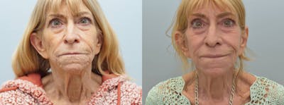 Laser Resurfacing  Before & After Gallery - Patient 144425754 - Image 1