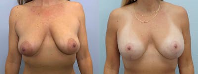 Breast Lift With Implants Before & After Gallery - Patient 144426703 - Image 1