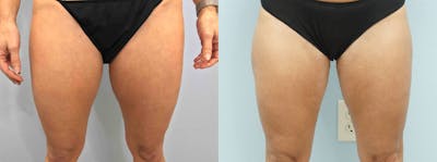 Liposuction Before & After Gallery - Patient 144426722 - Image 1
