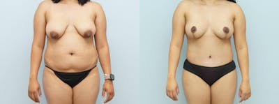 Mommy Makeover Before & After Gallery - Patient 144427145 - Image 1
