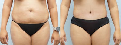 Tummy Tuck Before & After Gallery - Patient 144427264 - Image 1