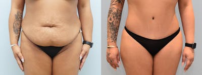 Tummy Tuck Before & After Gallery - Patient 144456900 - Image 1