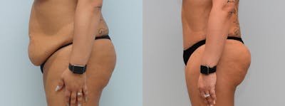 Brazilian Butt Lift Before & After Gallery - Patient 144456933 - Image 1