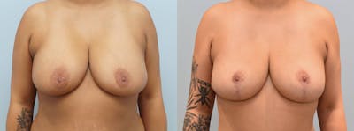 Breast Lift Before & After Gallery - Patient 144456947 - Image 1