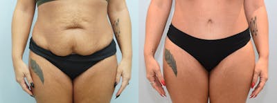 Tummy Tuck Before & After Gallery - Patient 144456992 - Image 1