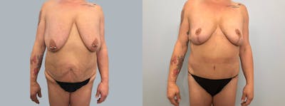 Mommy Makeover Before & After Gallery - Patient 144457022 - Image 1