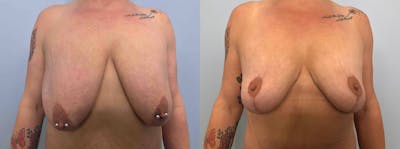 Breast Lift Before & After Gallery - Patient 144457069 - Image 1