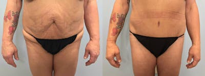 Body Lift Before & After Gallery - Patient 144457052 - Image 1