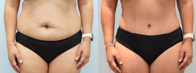 Tummy Tuck Before & After Gallery - Patient 144458765 - Image 1