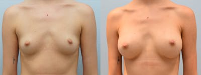 Breast Augmentation Before & After Gallery - Patient 144458811 - Image 1