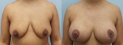 Breast Lift With Implants Before & After Gallery - Patient 144458823 - Image 1
