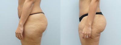 Brazilian Butt Lift Before & After Gallery - Patient 144458827 - Image 1