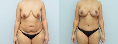 Mommy Makeover Before & After Gallery - Patient 144458834 - Image 1