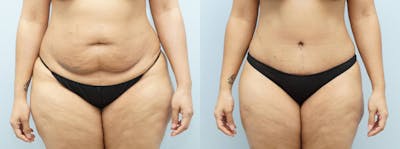 Tummy Tuck Before & After Gallery - Patient 144458840 - Image 1
