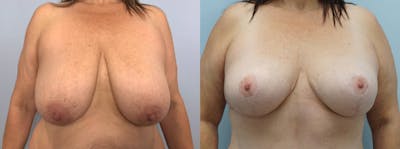 Breast Lift Before & After Gallery - Patient 144485538 - Image 1