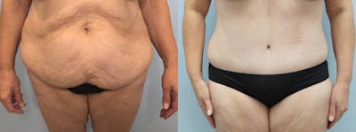 Body Lift Before & After Gallery - Patient 144485558 - Image 1