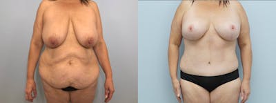 Mommy Makeover Before & After Gallery - Patient 144485571 - Image 1