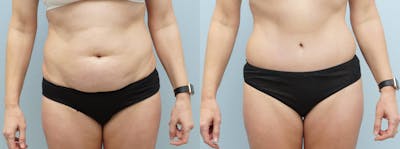 Tummy Tuck Before & After Gallery - Patient 144485581 - Image 1