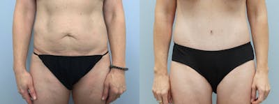 Tummy Tuck Before & After Gallery - Patient 144485607 - Image 1