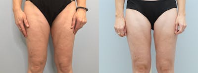 Thigh Lift Before & After Gallery - Patient 144485626 - Image 1