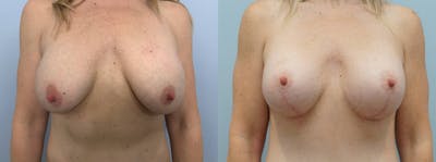 Breast Lift With Implants Before & After Gallery - Patient 144485878 - Image 1