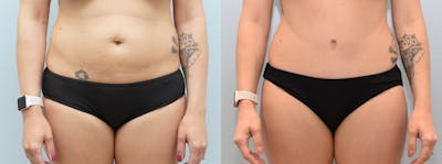 Tummy Tuck Before & After Gallery - Patient 144486108 - Image 1