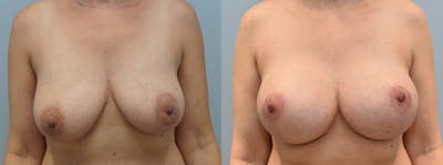 Breast Lift With Implants Before & After Gallery - Patient 144486891 - Image 1