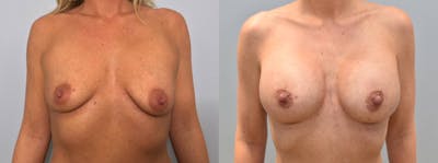 Breast Augmentation Before & After Gallery - Patient 144486960 - Image 1