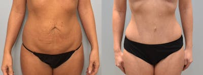 Tummy Tuck Before & After Gallery - Patient 144487021 - Image 1