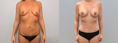 Mommy Makeover Before & After Gallery - Patient 144487050 - Image 1