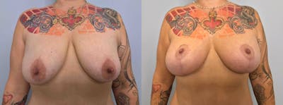 Breast Lift With Implants Before & After Gallery - Patient 144487067 - Image 1
