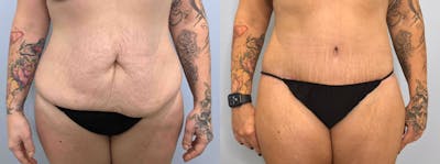 Body Lift Before & After Gallery - Patient 144487165 - Image 1
