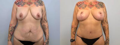 Mommy Makeover Before & After Gallery - Patient 144487188 - Image 1