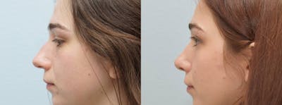 Rhinoplasty  Before & After Gallery - Patient 144487197 - Image 1