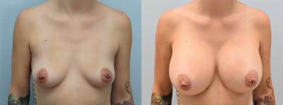 Breast Augmentation Before & After Gallery - Patient 146105259 - Image 1