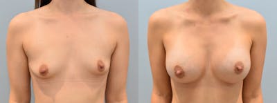 Breast Augmentation Before & After Gallery - Patient 146105269 - Image 1