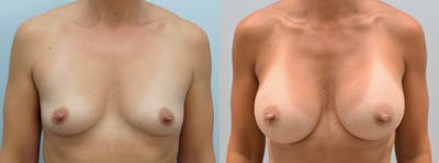 Breast Augmentation Before & After Gallery - Patient 146105273 - Image 1