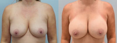 Breast Augmentation Before & After Gallery - Patient 146105283 - Image 1