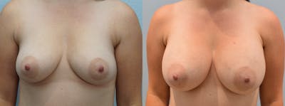 Breast Augmentation Before & After Gallery - Patient 146105288 - Image 1